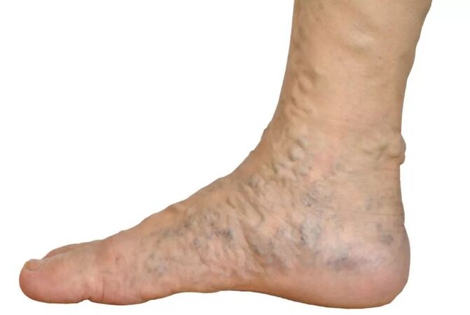Veens Diseases sur les jambes