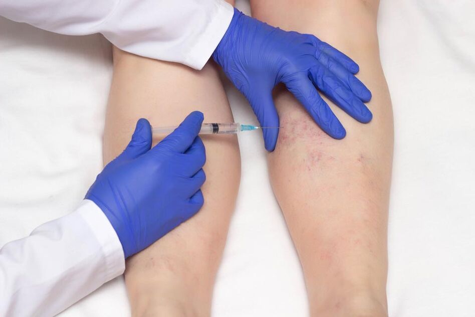 La sclérothérapie est une méthode de traitement des varices