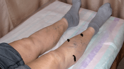 Traiter les varices avec des sangsues