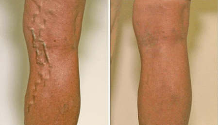 Varices aux 1er et 3ème stades de développement