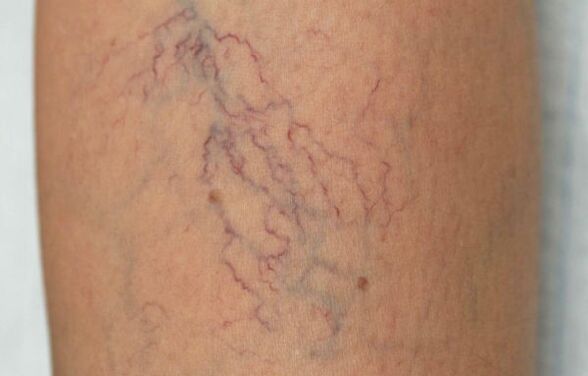Varices sur les jambes chez la femme