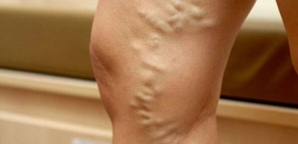 Varices sur les jambes des femmes