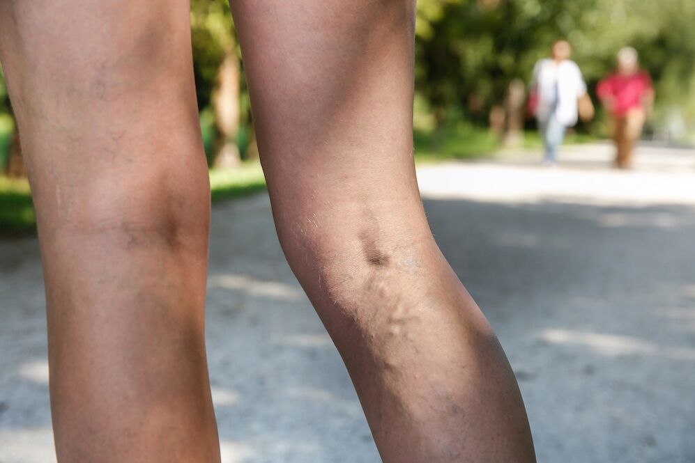 Varices sur les jambes