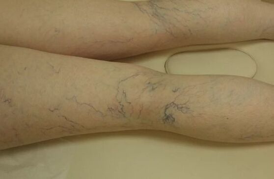 Crampe étoiles sur les jambes