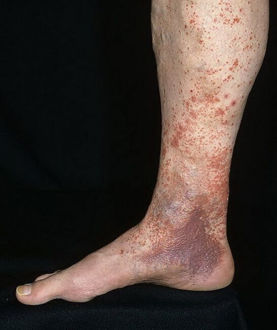 Dermatite de crampon