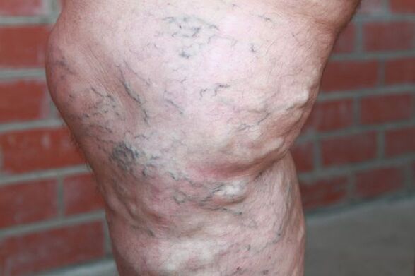 Signes de varices