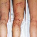Varices des jambes