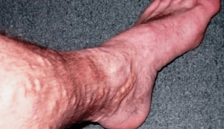 Causes des varices sur les jambes chez les hommes