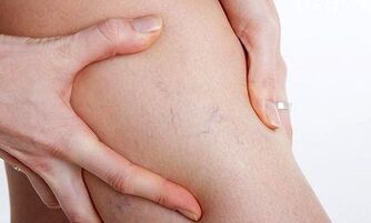 Raisons du développement des varices dans les jambes
