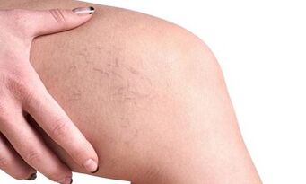 Stades de développement des varices