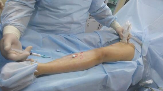 Chirurgie des varices sur les jambes
