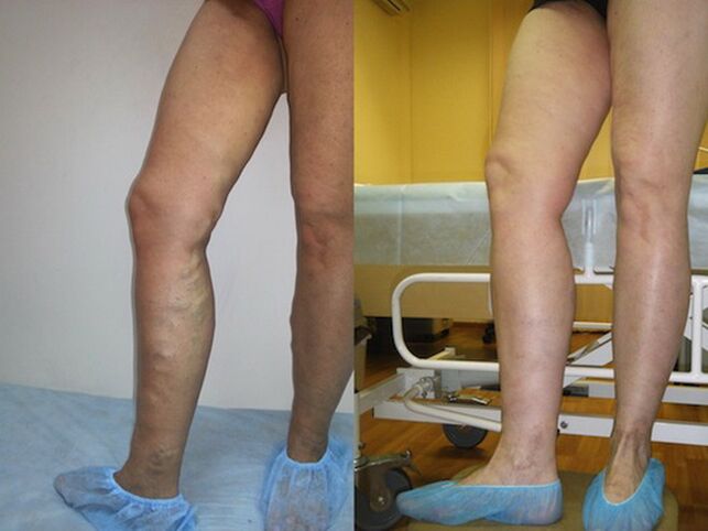 Jambes avant et après traitement laser des varices