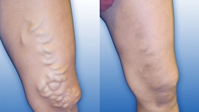 Jambes avant et après traitement sévère des varices
