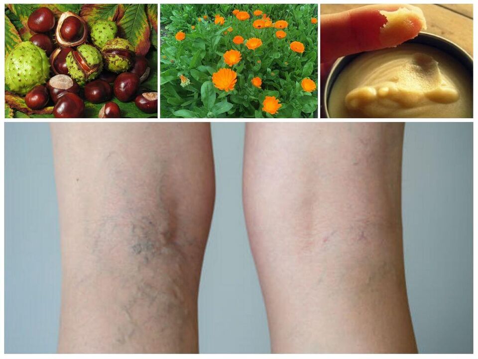 Varices sur les jambes et remèdes populaires pour la prévention