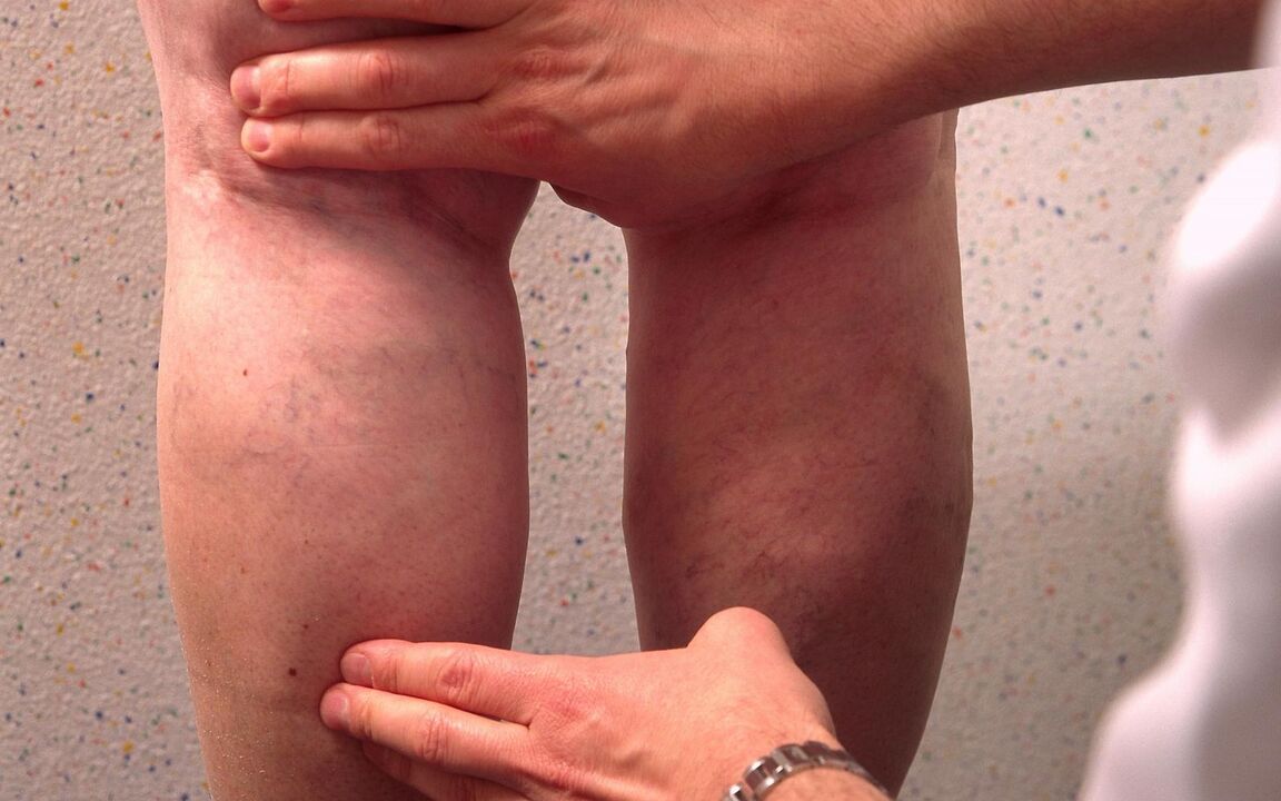 le médecin examine les jambes avec des varices